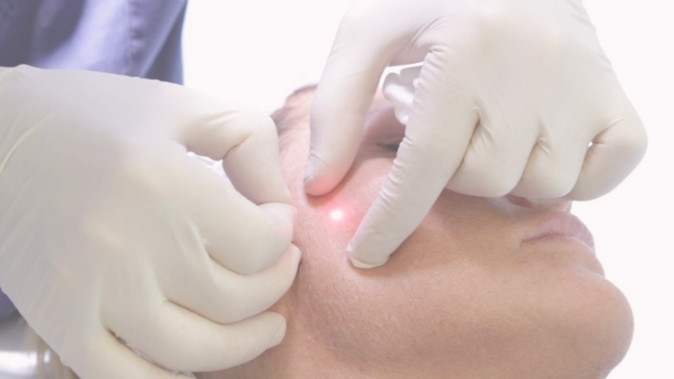 Endolift vs. Facelift 2025: Complete Guide & Best Choice