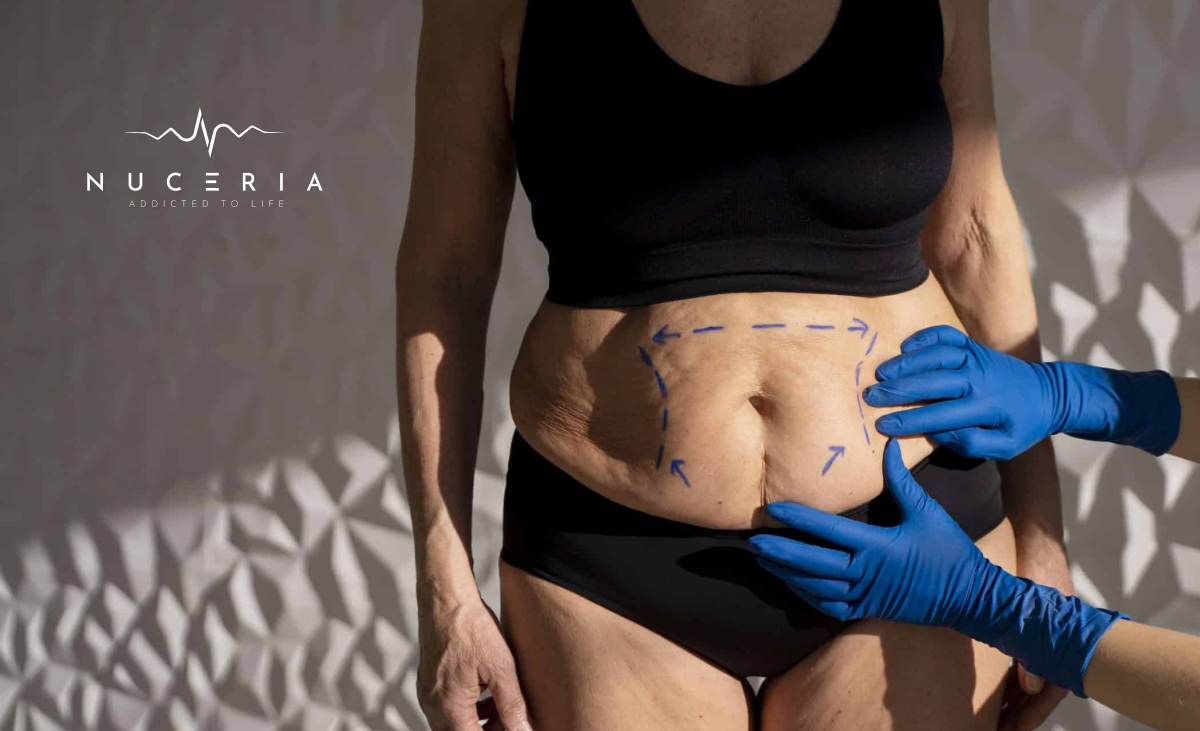 Endolift Miami | Expert Tummy Skin Tightening