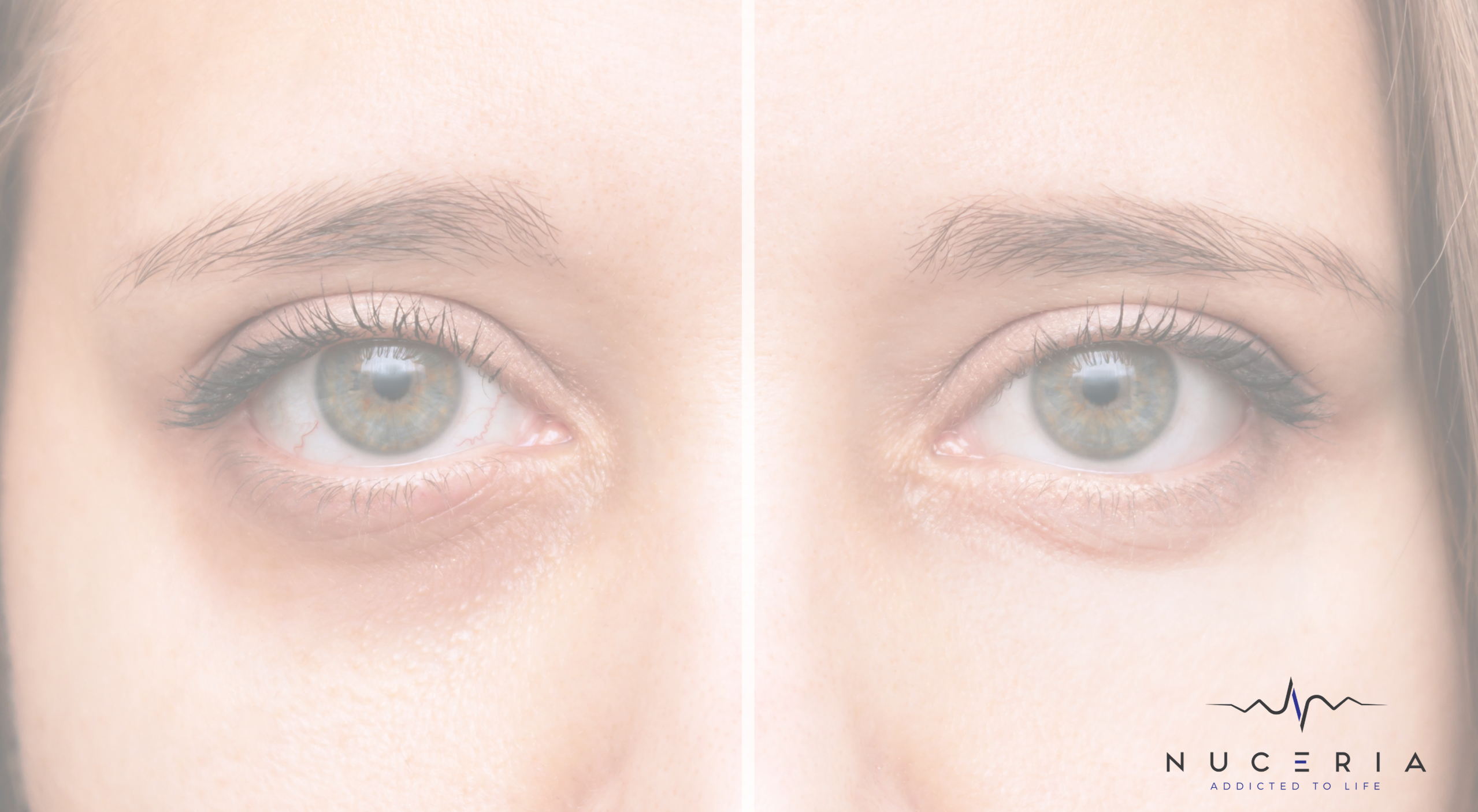 Dark Circles: Causes, Remedies, and Treatments