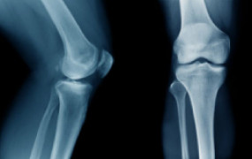 bone-density-health