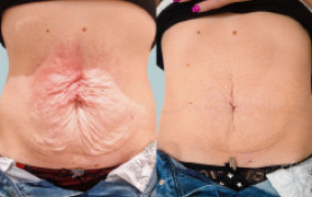 tummy-skin-tightening