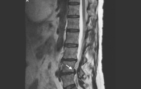 lumbar-spine-scan