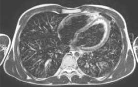 lung-health