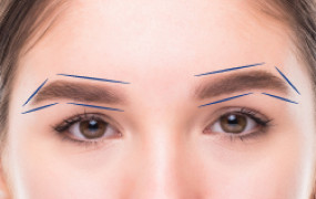 EYEBROW OR FOXTAIL LIFT