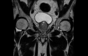pelvis-scan