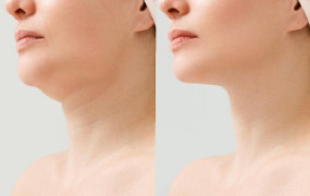 under-chin-reduction-endolift