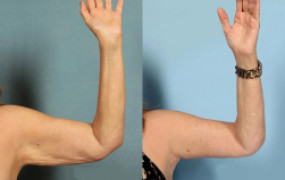 under-arm-endolift