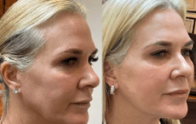 mandibular-contour-endolift