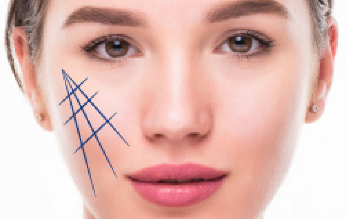 FULL CHEEKS AND JAW LIFT