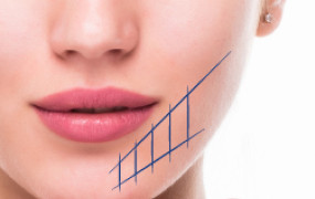 JAW LIFT AND DEFINITION