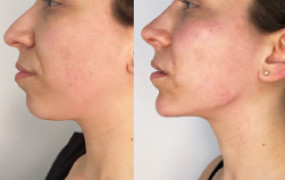 lower-mid-face-endolift