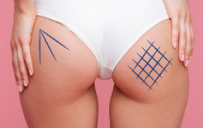 BUTTOCK LIFT