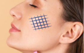 ACNE SCARRING