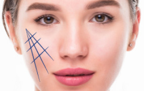 MINI CHEEK LIFT