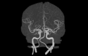 brain-blood-flow-health
